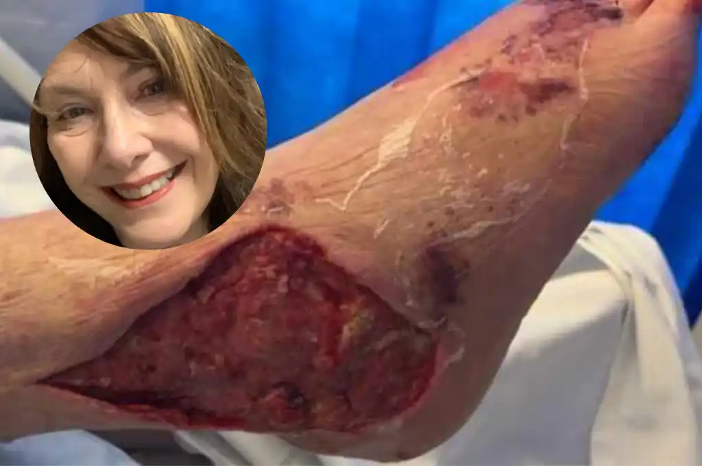 La fascitis necrotizante es una infección rara y mortal que afecta la piel y los tejidos subyacentes.