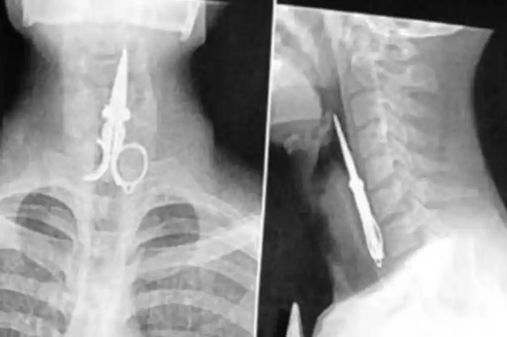 No fue necesaria una intervención quirúrgica.