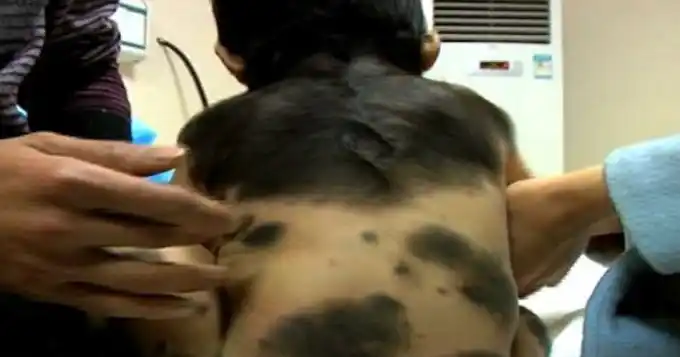 ¿De qué trata la enfermedad del bebé peludo? 