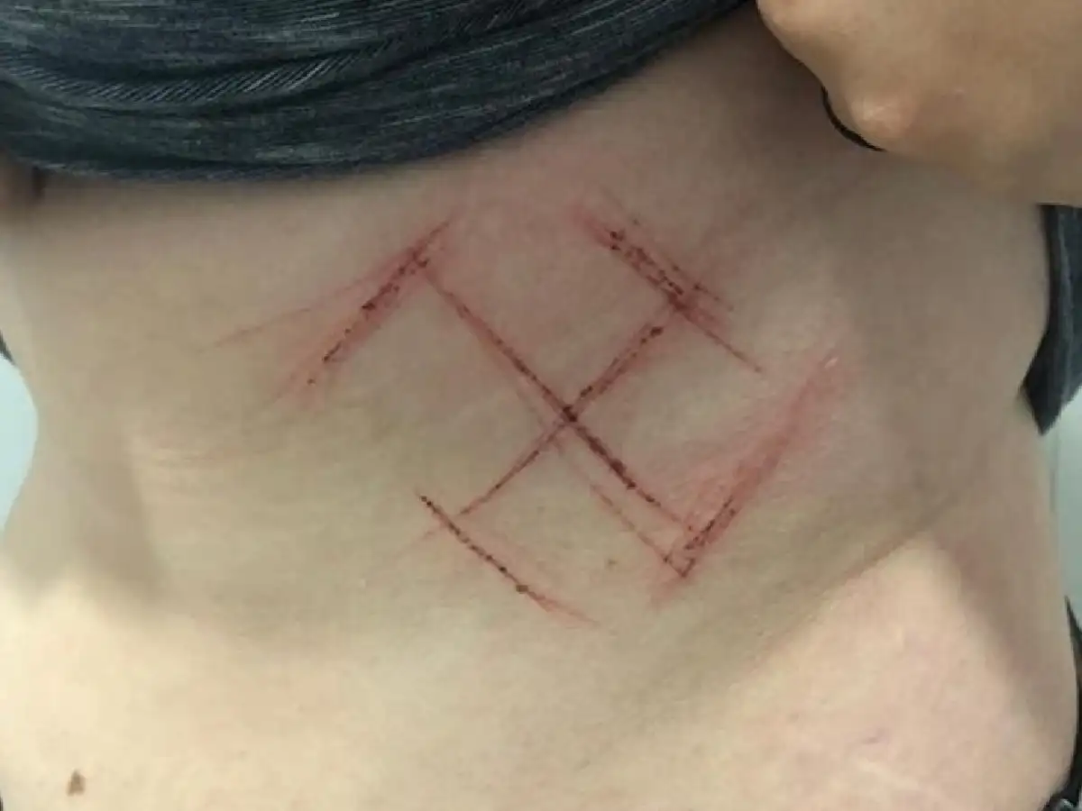 Efecto Bolsonaro: le marcaron una esvástica en la panza a una joven