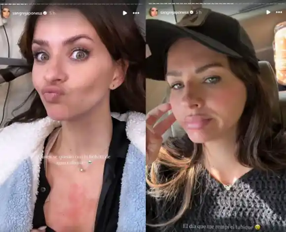 “Me rompí el tabique”: la China Suárez sufrió un accidente en pleno rodaje y mostró cómo le quedó la nariz