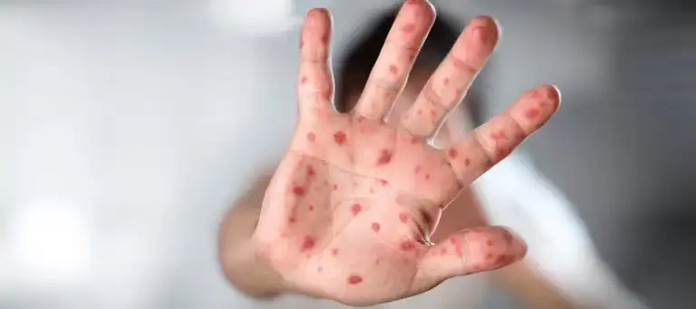 Alerta global por la viruela del mono: 6 preguntas clave sobre la Mpox respondidas por la OMS