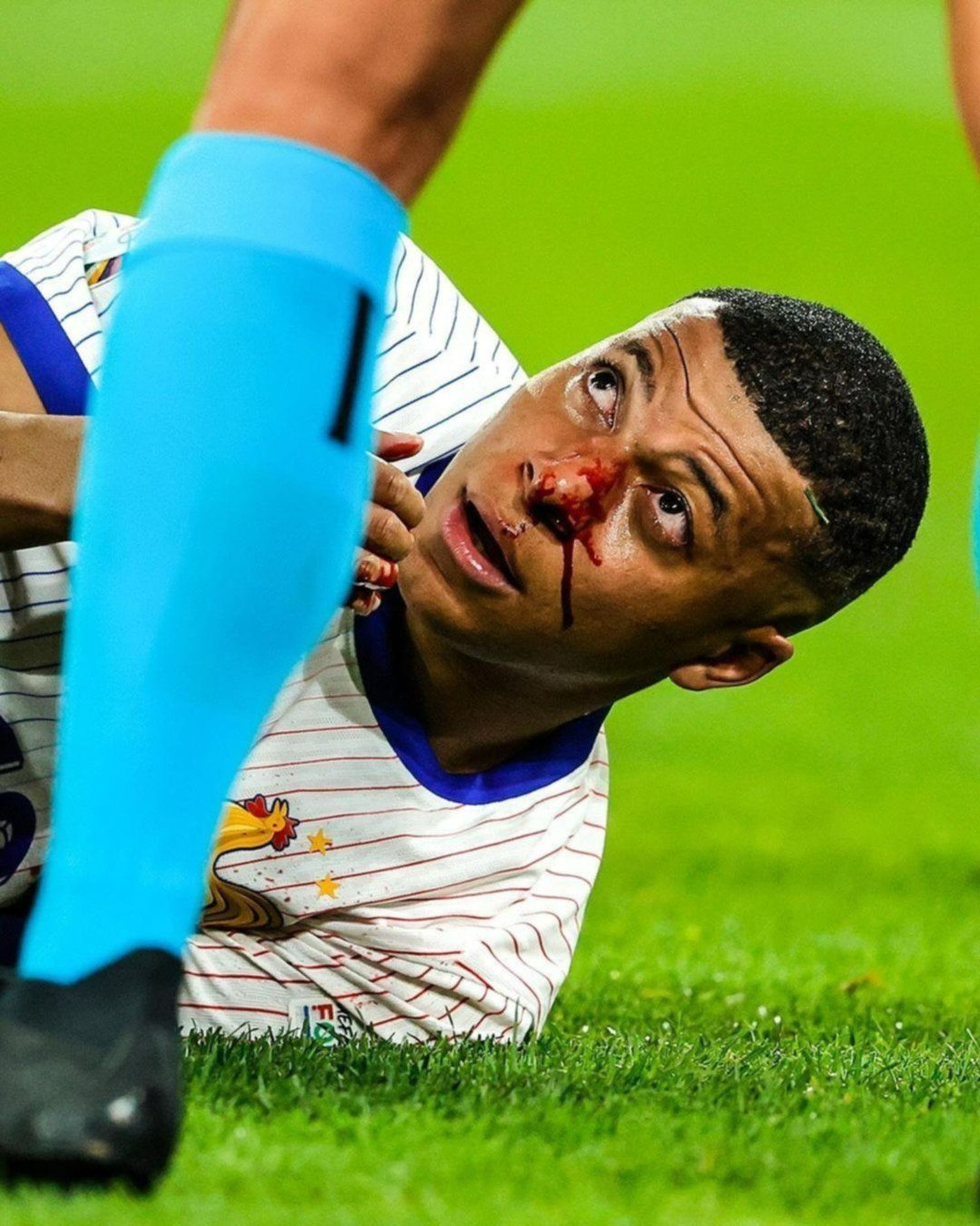 Kylian Mbappé: ¿Qué máscara usará tras fracturarse la nariz en la Eurocopa?