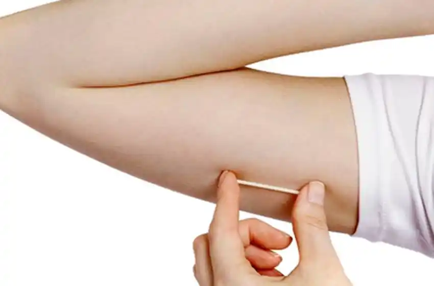 El implante subdérmico es el método anticonceptivo más elegido por las mujeres en la provincia
