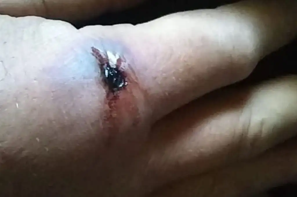 Buenos Aires: murió por la picadura de una araña y su familia denunció mala praxis