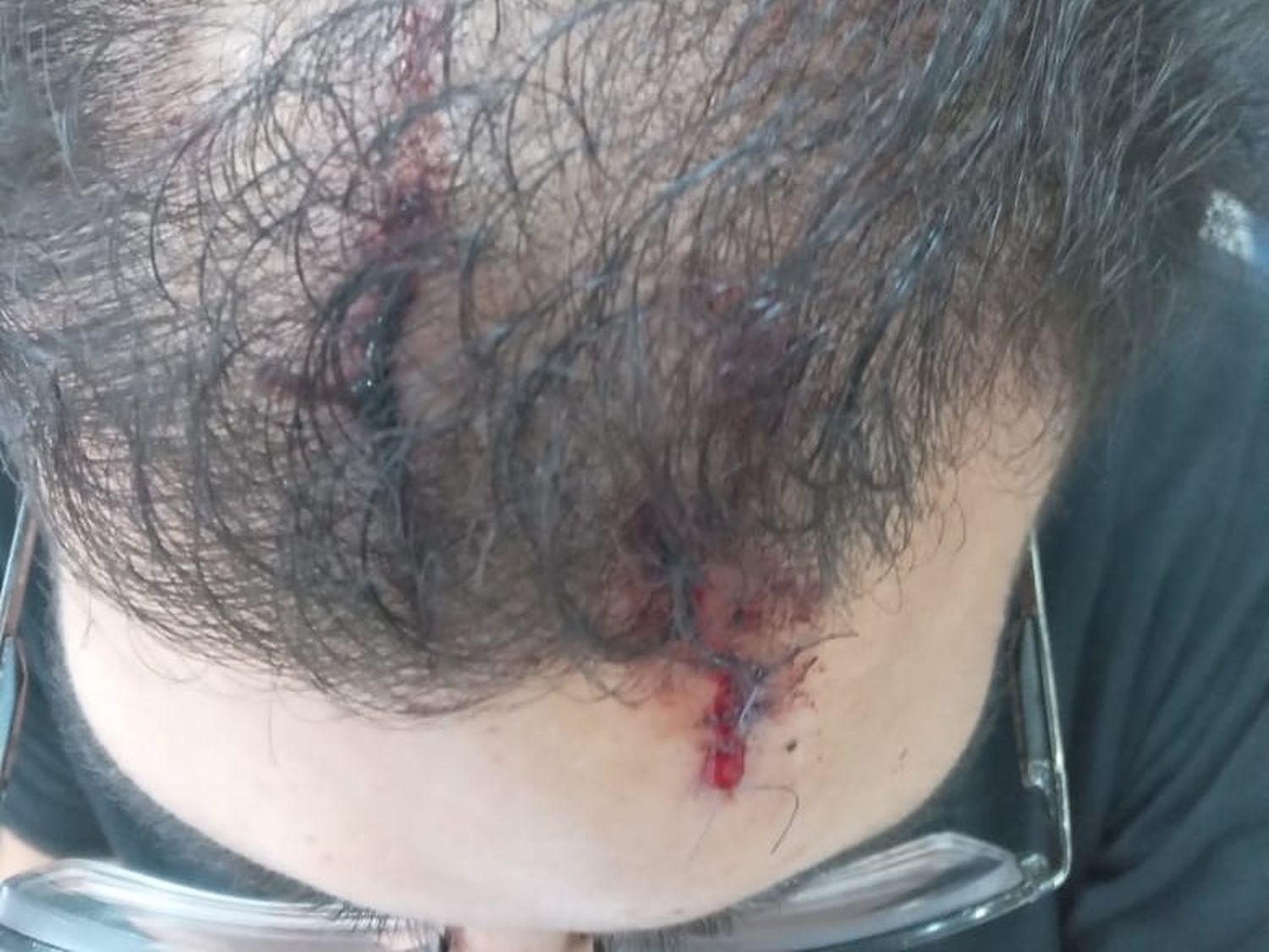 Un joven sufrió heridas en la cabeza tras el ataque de una persona armada con un palo