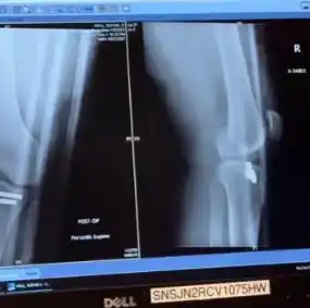 La foto que subió la modelo en sus redes sociales de la rodilla rota