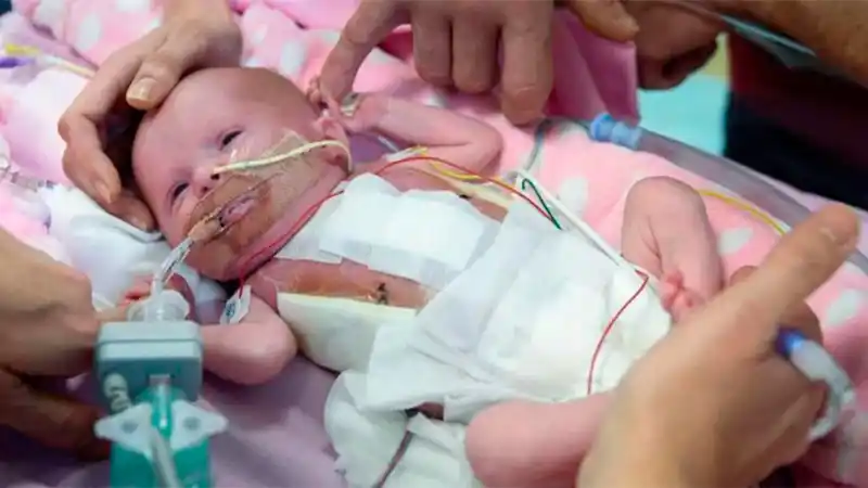 Beba nació con el corazón fuera de su cuerpo y tras varias cirugías sobrevivió