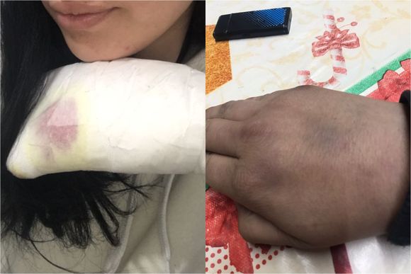 La joven baleada en la mano la semana pasada denunció que la siguen amenazando