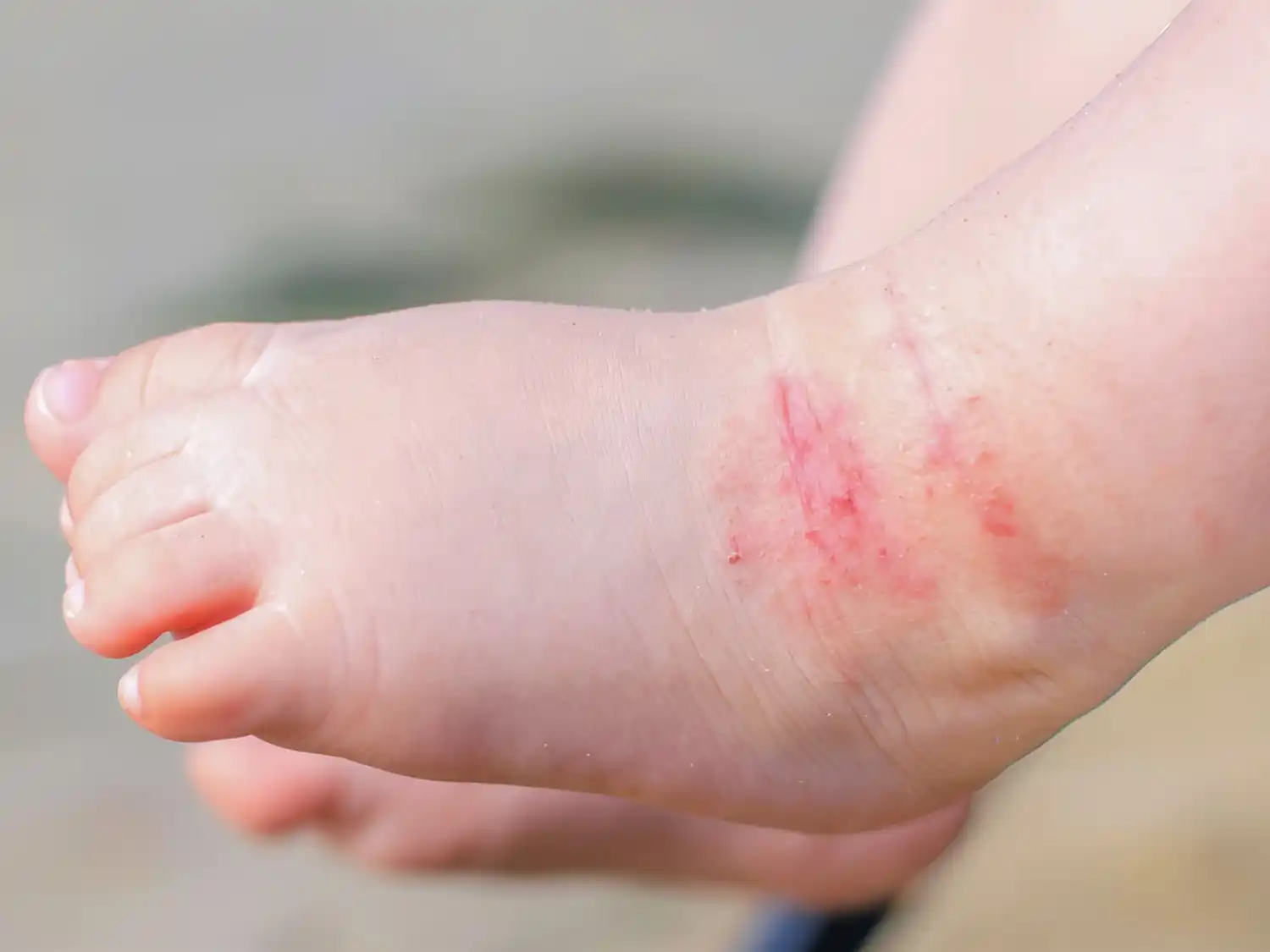 Salud recomienda cuidar la piel de los más chicos durante los meses de calor