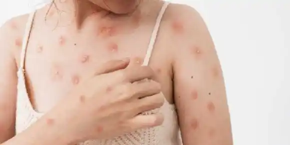 Viruela del mono: confirman dos nuevos casos en Córdoba y ya suman seis en la provincia