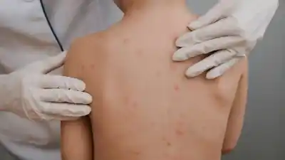 Aumentan los casos de varicela en Gualeguaychú y realzan la importancia de la vacuna