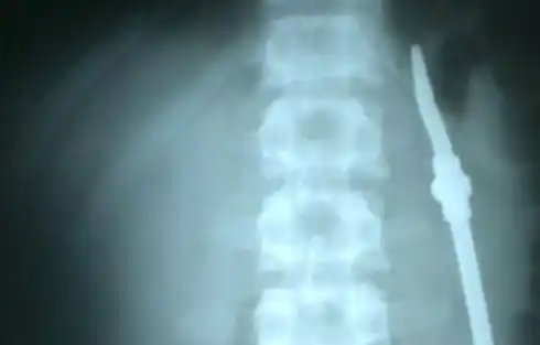 Entre Ríos: Operaron al preso que ingirió una bombilla