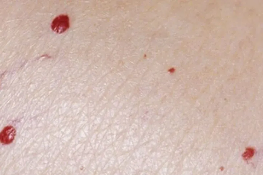 Piel - 2