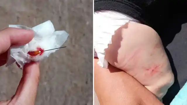La aguja que dejaron clavada en el pie del bebé. Imágenes sensibles.