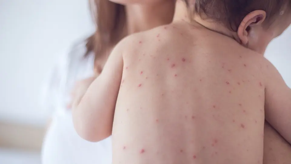 Brote de sarampión en el AMBA