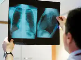 Cáncer de pulmón: una enfermedad que sigue desafiando a la ciencia y exige un compromiso colectivo