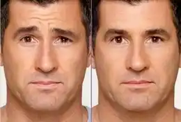 botox