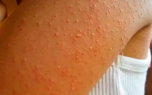 ¿Porqué salen estos granitos en el brazo?