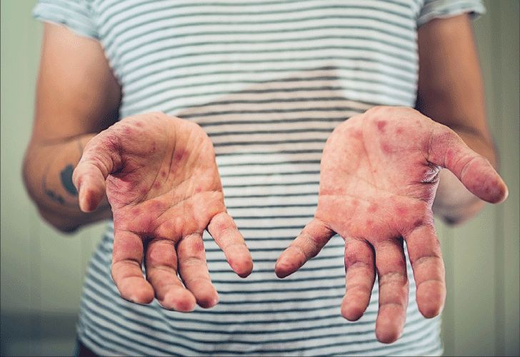 Sarampión: una mujer antivacunas y sus cinco hijos, los últimos casos confirmados