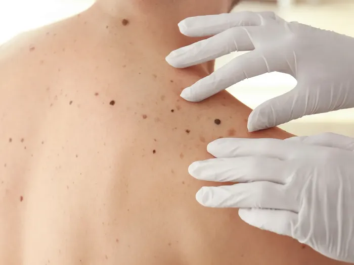 Día Mundial del Cáncer de Piel: la importancia del autoexamen para la detección precoz