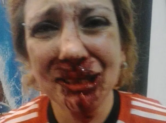 Tras el superclásico, un hincha de Boca desfiguró a una mujer que festejaba el triunfo de River