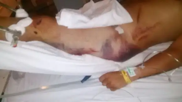 Denuncia que un patrullero sin luces lo chocó y le provocó fracturas
