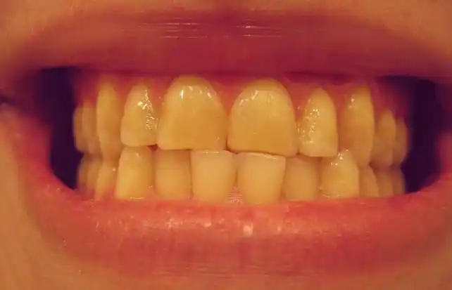 El nuevo truco para blanquear los dientes ya es furor en todo el mundo
