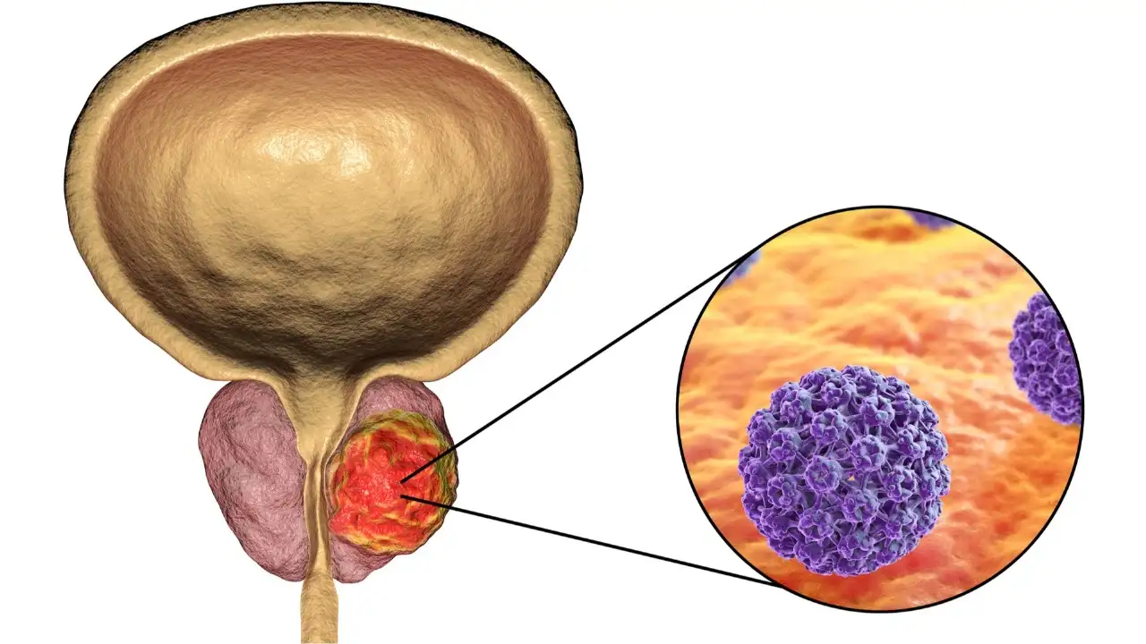Tumor prostático-