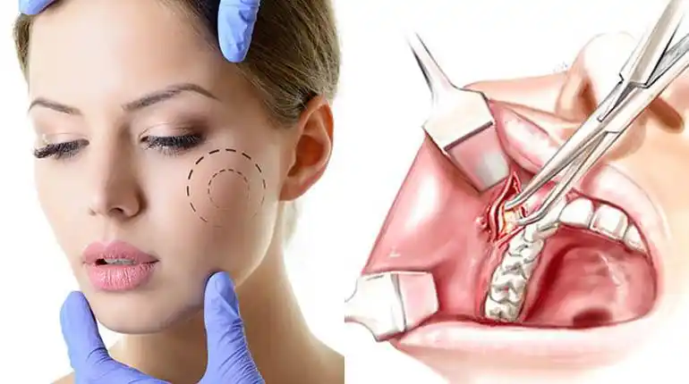 Como obtener un Rostro Anguloso de manera mininvasiva