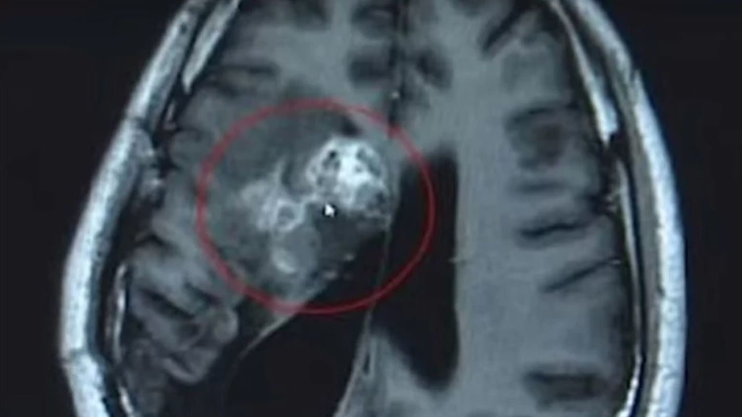 Le extirparon de la cabeza un parásito vivo que comió su cerebro durante 15 años