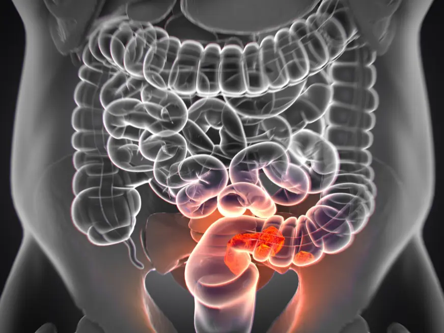 Cáncer de colon.