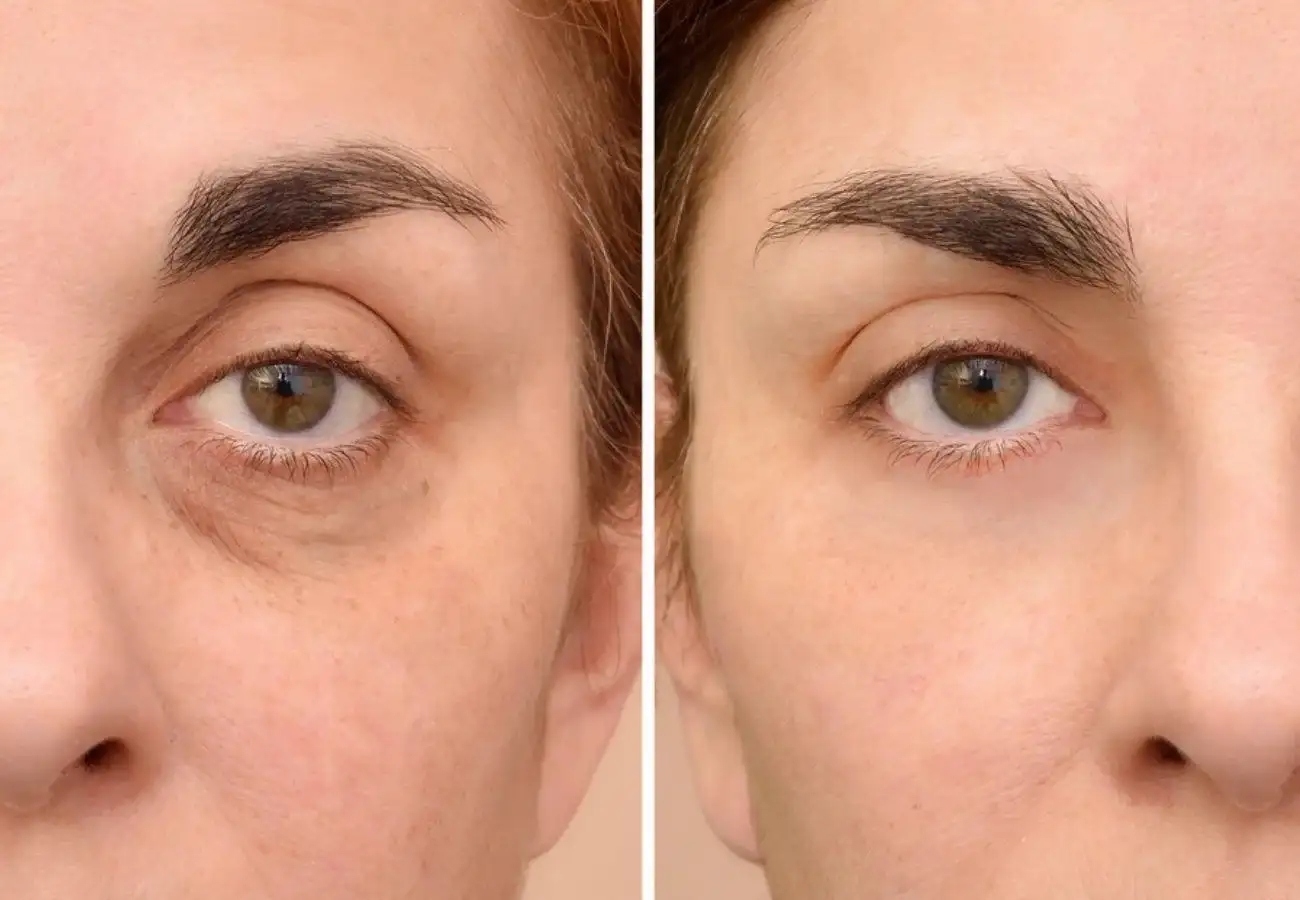 En algunos casos, las ojeras pueden indicar la necesidad de cambios en el estilo de vida.