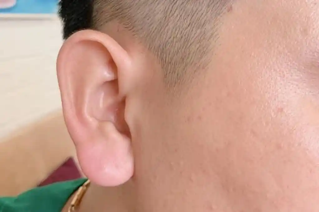 “Orejas de Buda de la fortuna”, la tendencia estética en hombres que afecta a la salud