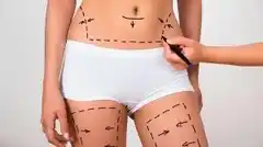 Aspectos a tener en cuenta a la hora de pensar en una lipoescultura