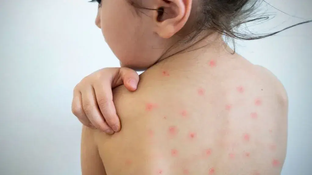 Piden estar atentos ante la aparición de síntomas.