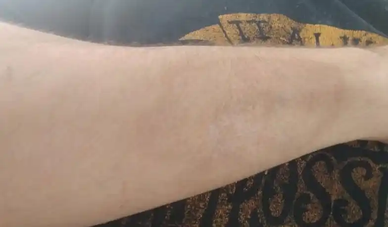 Así tiene el brazo en la actualidad  