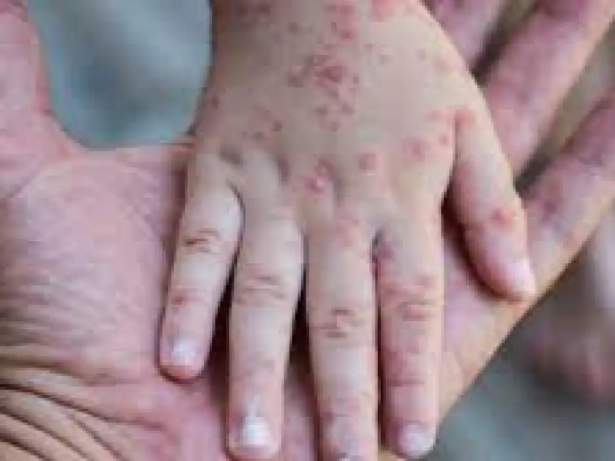 Primer caso de viruela del mono en la provincia de Córdoba