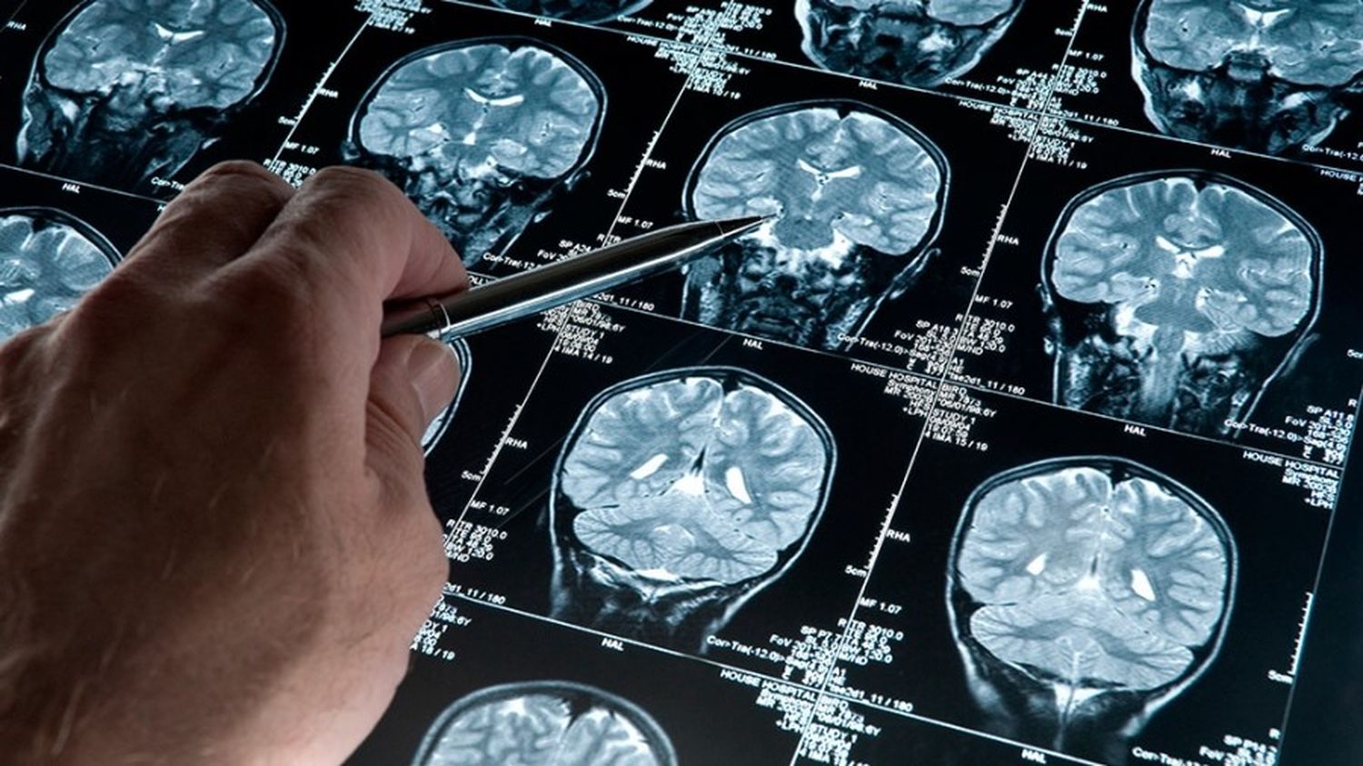 La enfermedad Alzheimer podría ser detectada veinte años antes de La aparición de síntomas