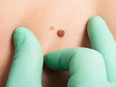 Desarrollo argentino: una vacuna terapéutica para casos del cáncer de piel