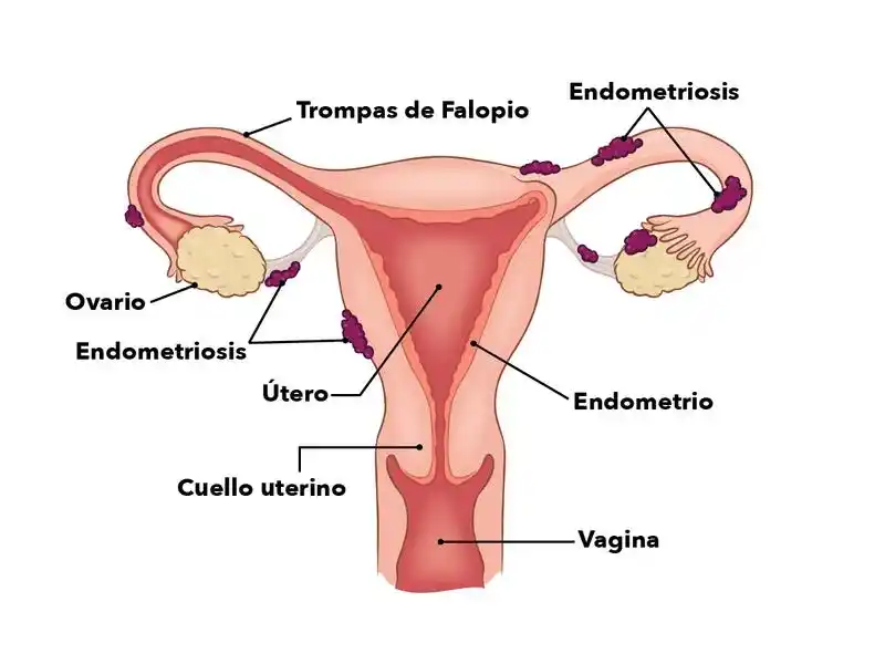 El 14 de marzo, se conmemora el Día Mundial de la Endometriosis.