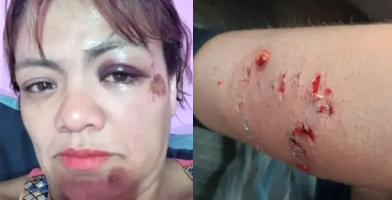 Villa La Angostura: una mujer fue brutalmente atacada por una jauría de perros cuando paseaba en bicicleta