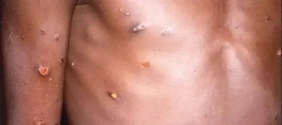 Viruela del mono: ¿qué aprendieron los médicos en el Reino Unido a lo largo de los años?