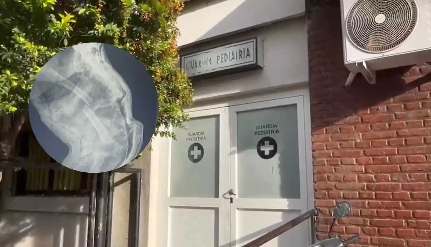 La radiografía de Emma, la beba atendida en la Guardia de Pediatría.