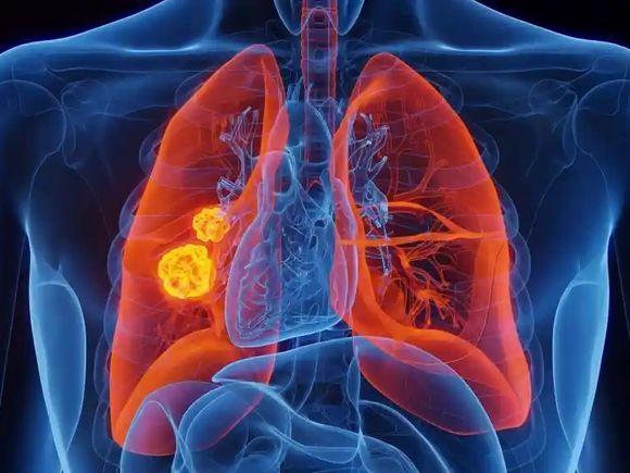 “Unidos por lo Único”: Día Mundial contra el cáncer