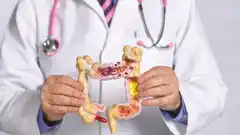 Cuántos casos de cáncer de colon se diagnostican a diario