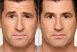 botox