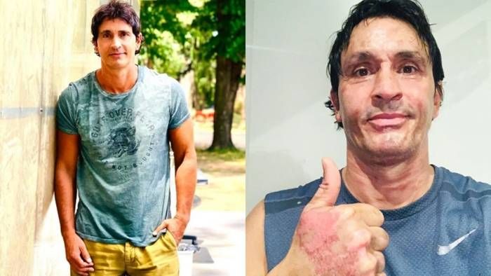 Sebastián Estevanez: imágenes impactantes de las quemaduras que sufrió por un accidente doméstico