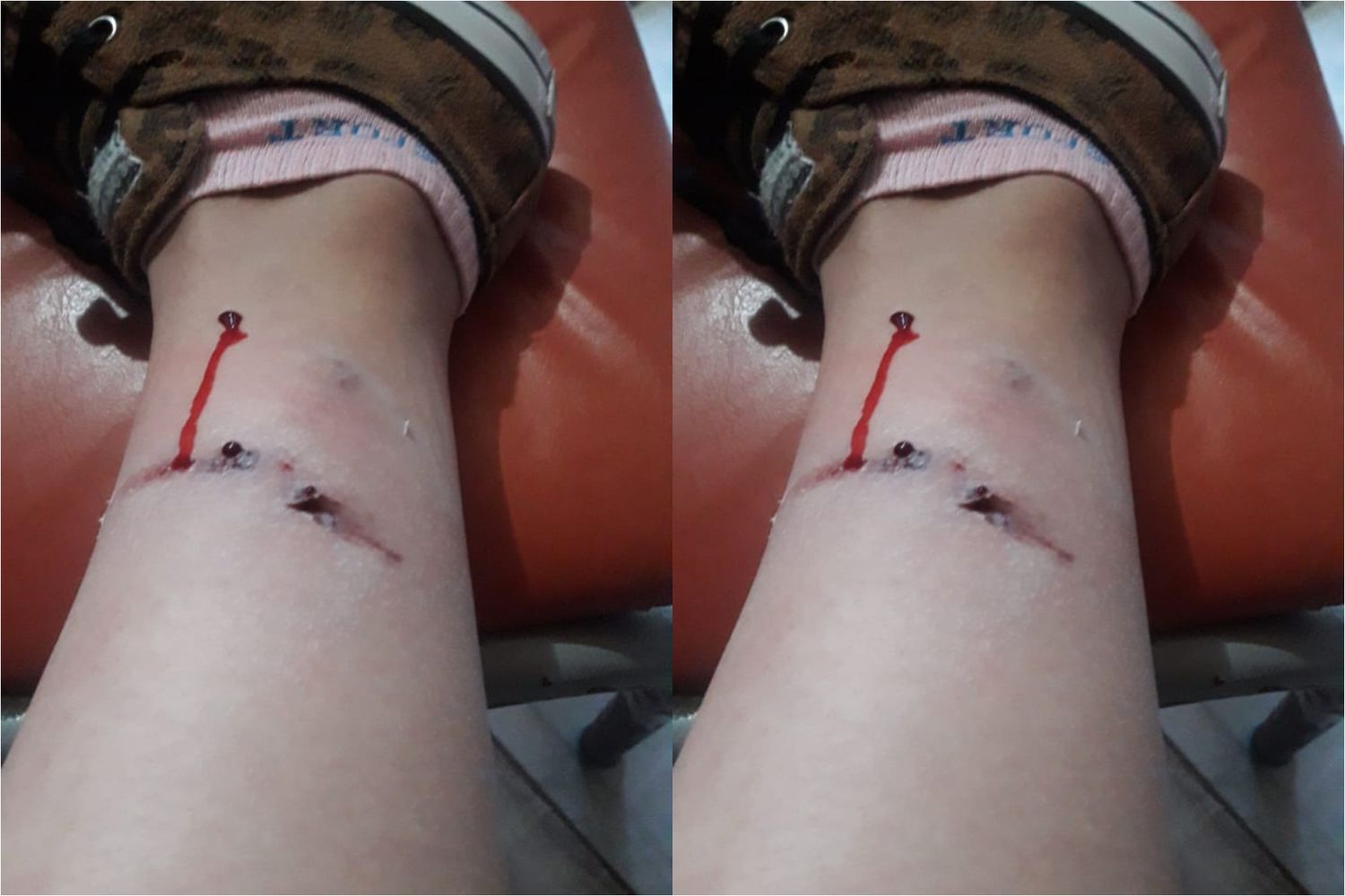 Perros en la costanera: mordieron a un joven que iba en moto
