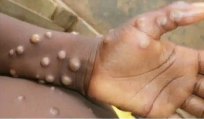 Detectan en EE.UU. un caso de viruela del mono